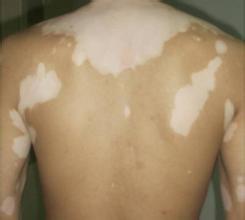 学会白癜风护理方法 康复轻而易举.jpg