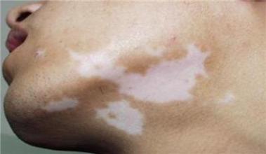 白癜风日常护理注意事项有哪些 白癜风日常护理注意事项有哪些.jpg