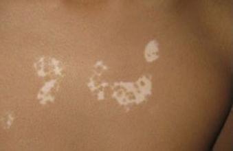 治疗白癜风的步骤有哪些呢 治疗白癜风的步骤有哪些呢.jpg